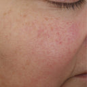 Before and after results of person’s face before and after using the skin renewing night cream, The Night Synthesis